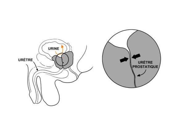 hypertrophie de la prostate et difficulté à uriner