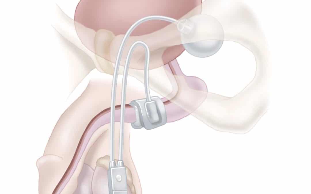 Incontinence urinaire chez l&rsquo;homme après prostatectomie pour cancer.