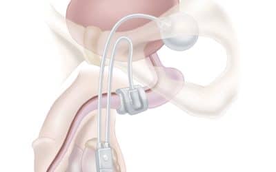 Incontinence urinaire chez l&rsquo;homme après prostatectomie pour cancer.