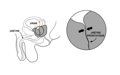 Comprendre l&rsquo;Hypertrophie Bénigne de la Prostate : Vos Options de Traitement Chirurgical et Mini-Invasif en 2026