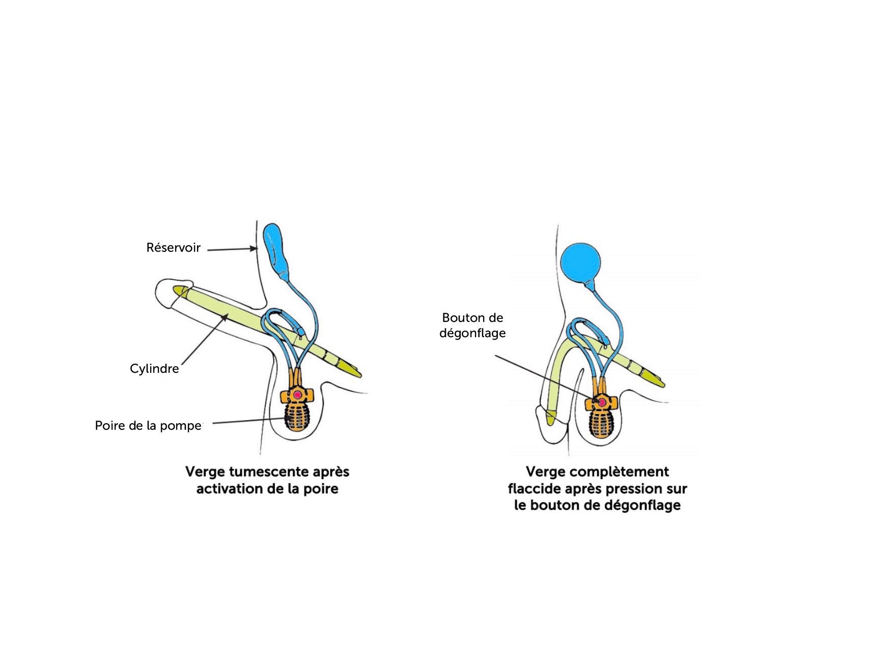 3 fonctionnement dun un implant gonflable ams 700 final pdf
