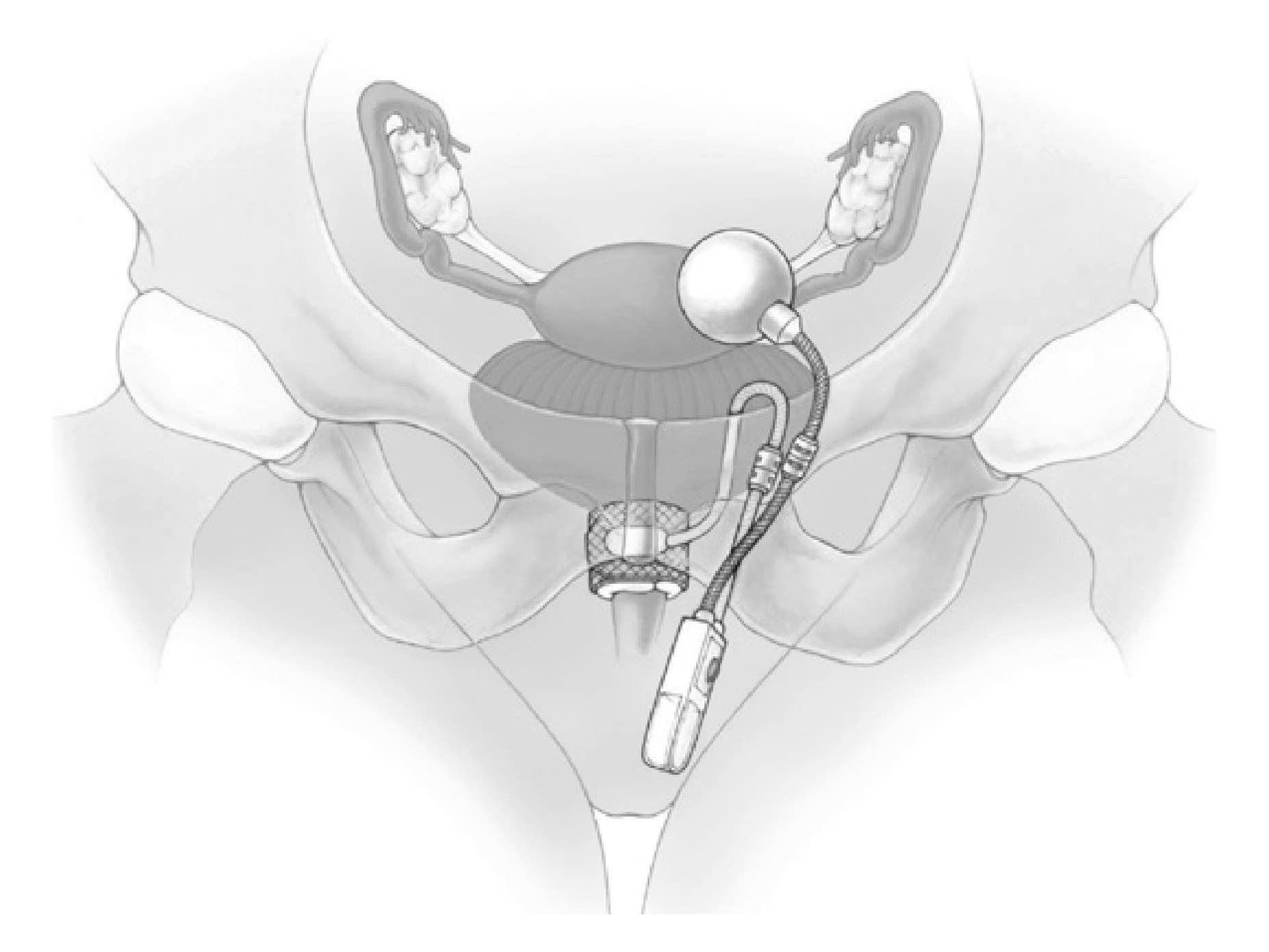 4 .sphincter artificiel urinaire ams 800 chez la femme 1 4 .sphincter artificiel urinaire ams 800 chez la femme 1