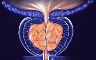 L&rsquo;évolution d’un adénome de la prostate.