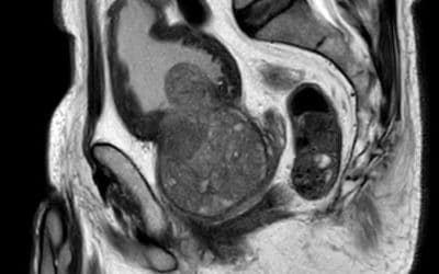 Quelles sont les causes de l’hypertrophie de la prostate ?