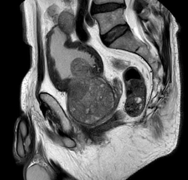 hypertrophie prostatique et vieillissement vue sur une échographie de la prostate d'un homme