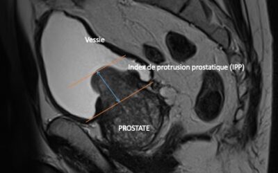 Retentissement du lobe médian sur l&rsquo;hypertrophie de la prostate.