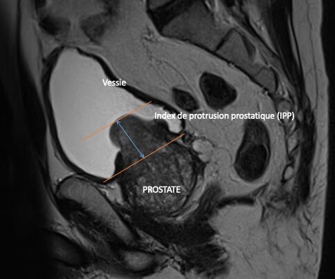 L'échographie comment de l'Index protrusion prostatique (IPP) et blocage urinaire