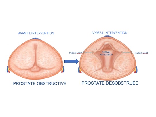 avant apres pose implants uriloft pdf