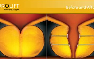 Les avantages des implants Urolift pour traiter l&rsquo;adénome de la prostate
