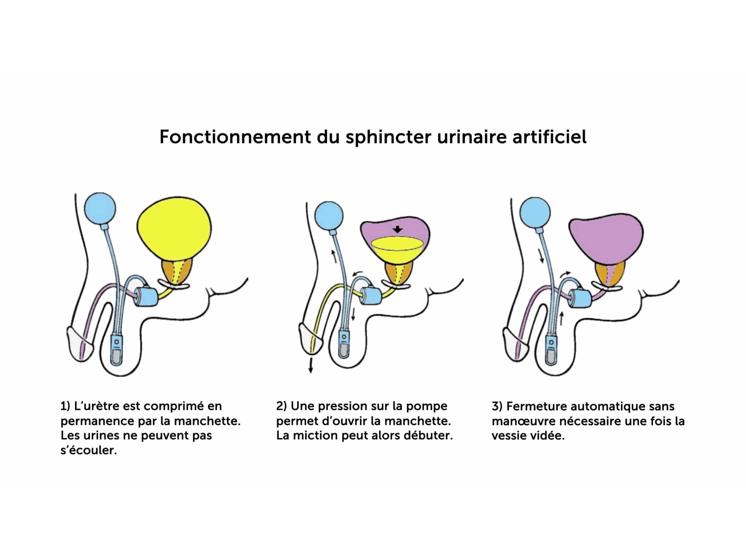 3. fonctionnement dun sphincter artificiel urinaire ams 800 final 3. fonctionnement dun sphincter artificiel urinaire ams 800 final
