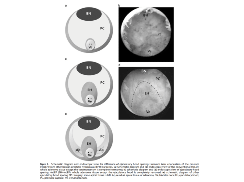 adénome de la prostate (HoLEP): préservation de l'éjaculation