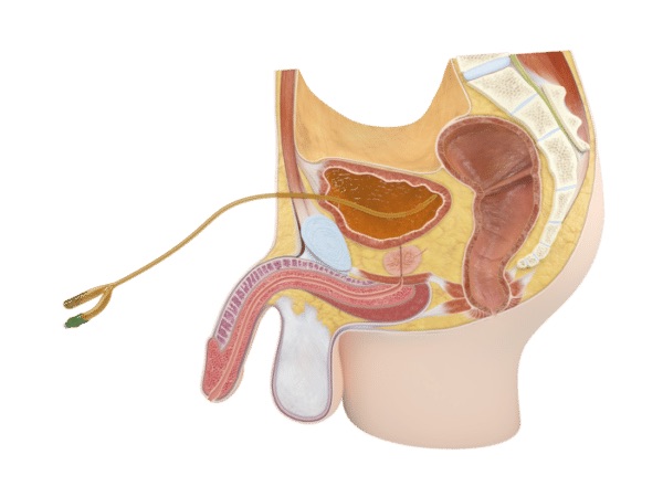 catheter sus-pubien et rétention urinaire
